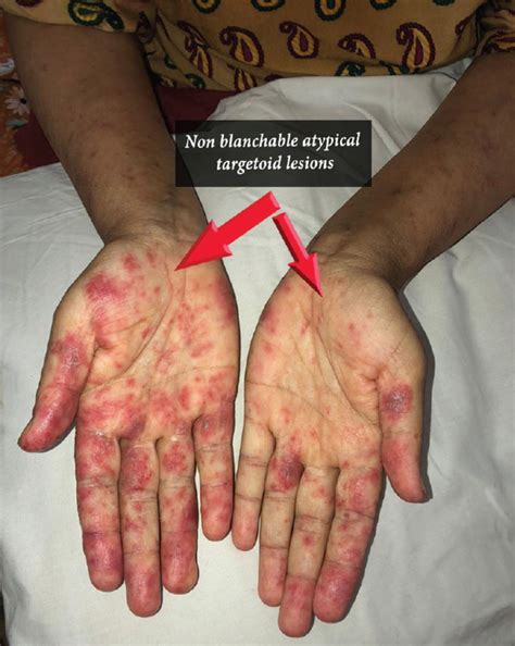 Chronic Cutaneous Lupus Erythematosus