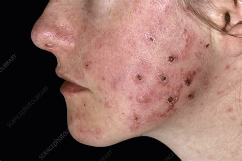 Lupus - What Causes the Lupus Butterfly Rash? - Redorbit : Find out ...