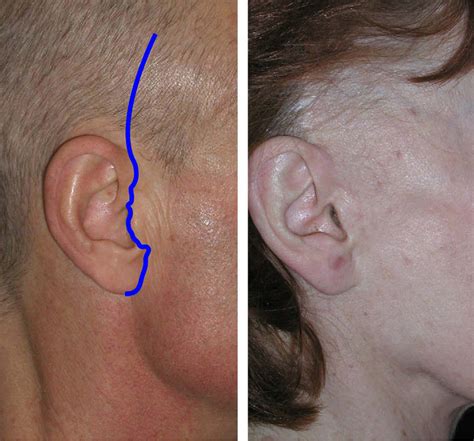 Figure 33 from Complications in facelift surgery and their prevention ...