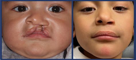 Cleft Lip Surgery Before And After