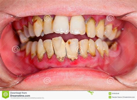 Acute necrotizing ulcerative gingivitis