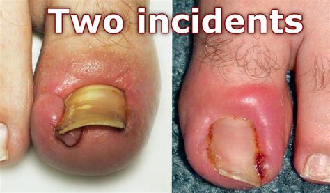 What To Do After Ingrown Toenail Removal