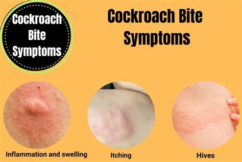 Cockroach Bite Symptoms and Treatment at Home - A Visual Guide - The ...