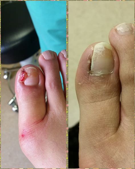 Toenail Removal