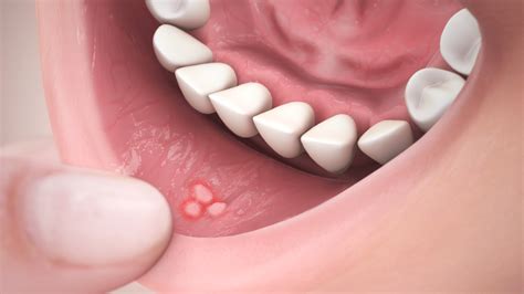 Canker Sores: Causes, Symptoms, Treatment and Medication