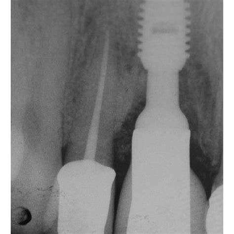 A. Crossectional view of an ankylosed tooth in situ (CBCT); B ...