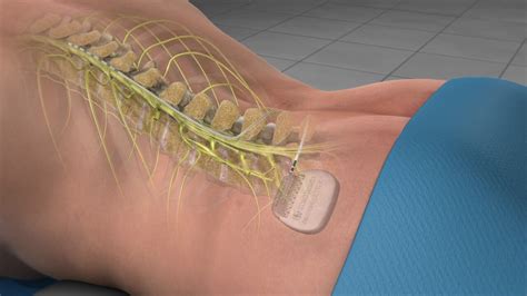 Spinal Cord Stimulator — EPIC PAIN MANAGEMENT