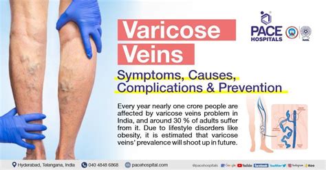 Varicose Veins – Symptoms, Causes, Complications And, 40% OFF