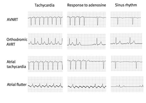 Ventricular Tachycardia Vs Supraventricular Tachycardia