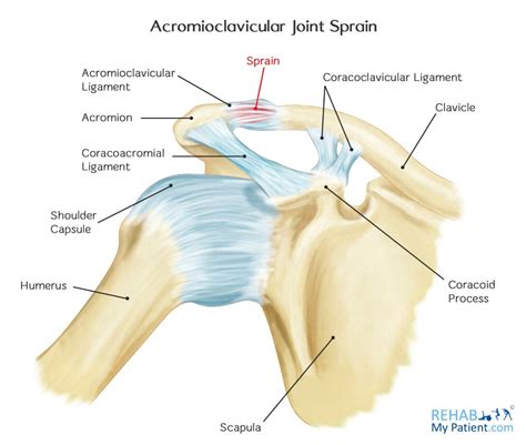 Acromioclavicular Joint Sprain | Rehab My Patient