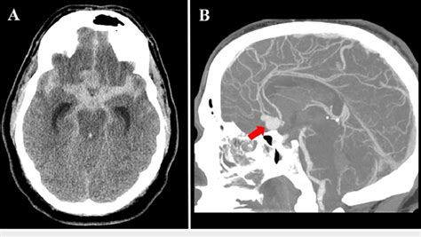 Non-contrast head CT and CT angiogram in the preoperative period ...