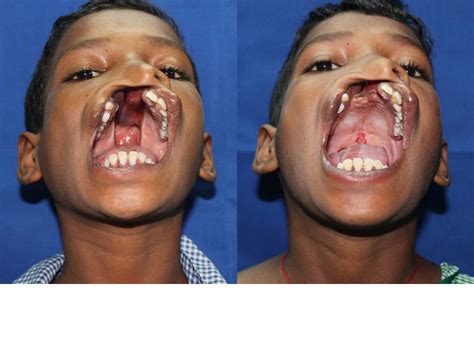 FREE CLEFT LIP AND PALATE SURGERY IN DELHI: A 12 years with a wide cleft