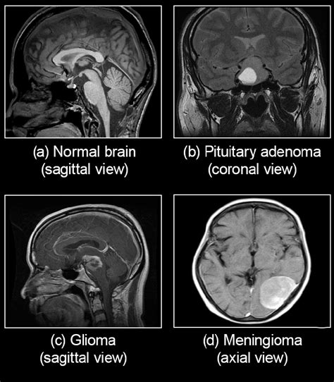 MRI scans of the normal brain and brain have different tumorous growth ...