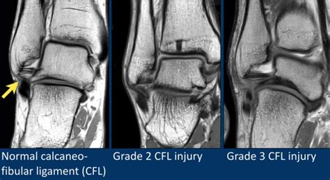 Medial Ankle Ligaments Mri