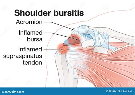 Shoulder Bursitis As Medical Painful Bursa Inflammation Outline Diagram ...