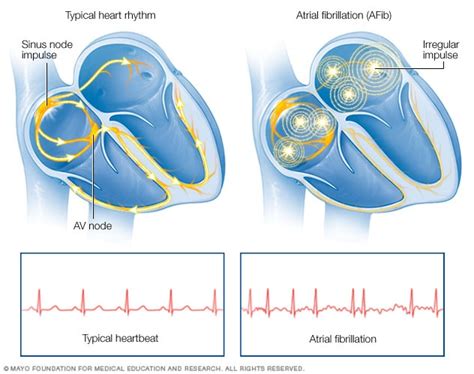 Atrial fibrillation - Symptoms and causes - Mayo Clinic