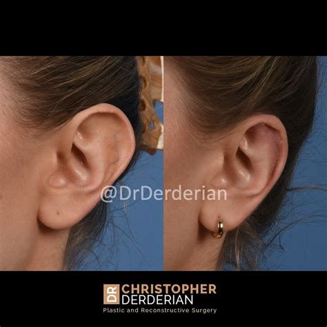 Reduction Otoplasty — Dr Derderian — Plastic and Reconstructive Surgery