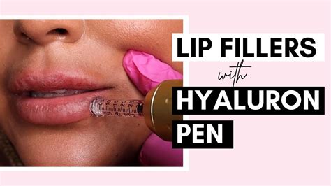 No Needle Lip Filler With Hyaluron Pen | Procedure And Aftercare Ft ...