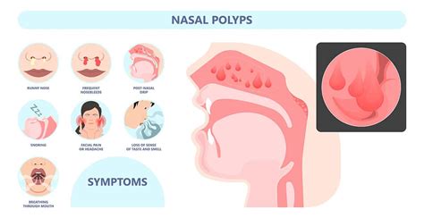 Nasal Polyps in Singapore - Allergy & Sinus ENT | Dr Soma