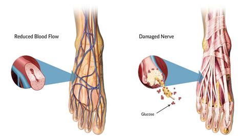 Diabetic Neuropathy: Symptoms and Causes