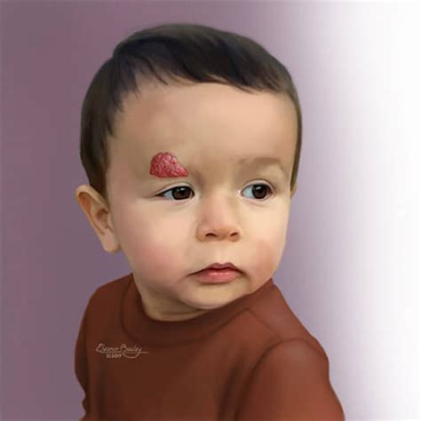 Infantile Hemangioma | Johns Hopkins Medicine