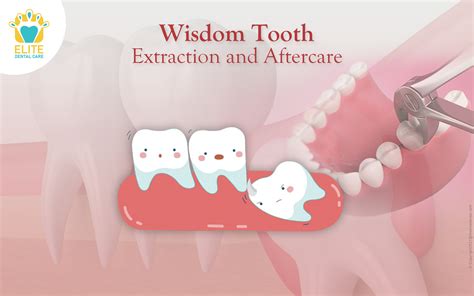 07 Wisdom Tooth Extraction and Aftercare | Elite Dental Care