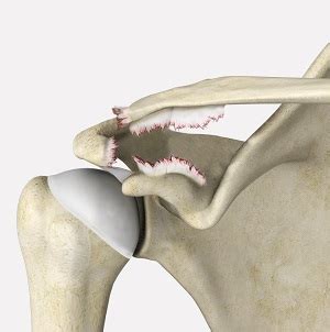 Shoulder Ligament Injuries Montgomery, AL | Shoulder Surgeon Birmingham, AL