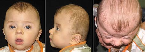 Craniosynostosis causes, symptoms, treatment & craniosynostosis surgery