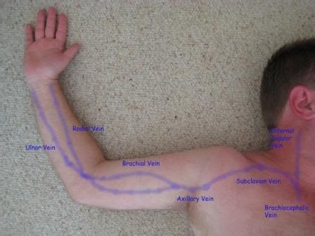 Arm DVT Normal - Ultrasoundpaedia | Vascular ultrasound, Diagnostic ...