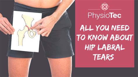 All you need to know about Hip Labral Tears - PhysioTec