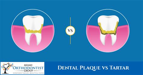 Dental Plaque vs Tartar - Miami Orthodontist Group