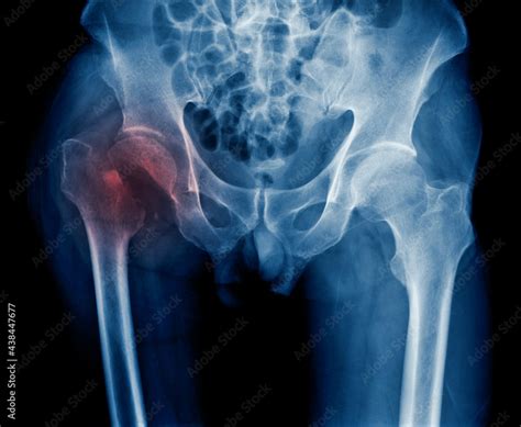 x-ray hip fracture of old man, x-ray image intertrochanteric fracture ...