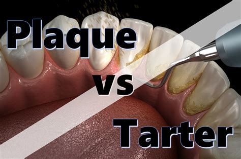 Differentiating Between Plaque and Tartar, plaque - okgo.net