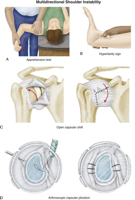 Multidirectional Shoulder Instability | Musculoskeletal Key