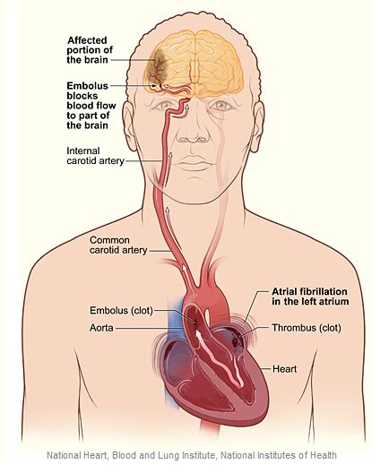 Overview of Atrial Fibrillation