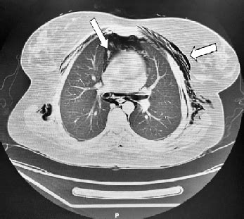 CT-scan chest demonstrating subcutaous emphysema. | Download Scientific ...