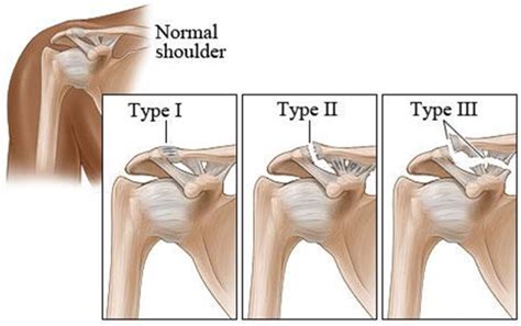 Acromioclavicular (AC) Joint | Acromioclavicular (AC) Joint Treatment ...