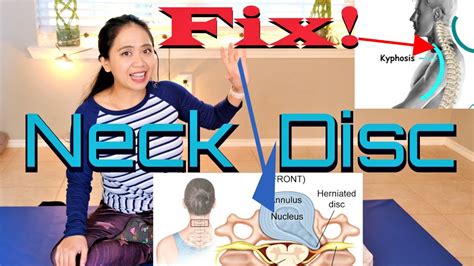 C6-C7 Herniated Disc Neck Pain and Weakness Exercises Relief - YouTube