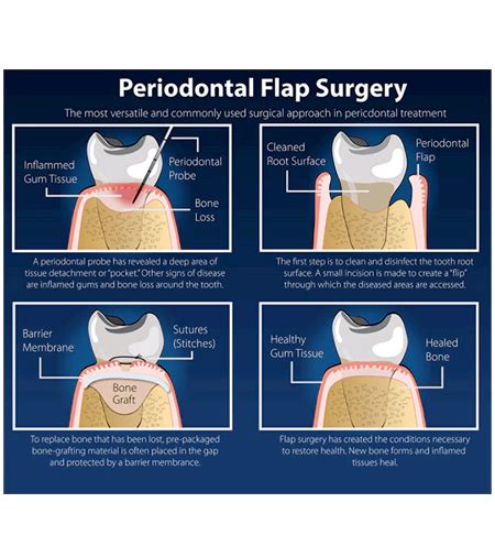 Flap Surgery & Gum Surgery in Hyderabad, India at FMS DENTAL