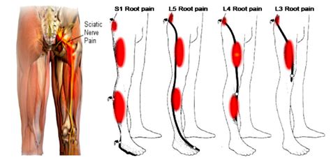 Sciatica – Acuupain