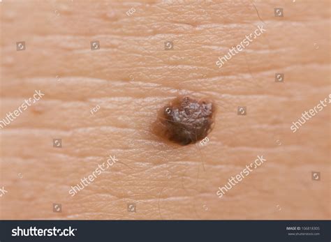 Macro Intradermal Nevus On Caucasian Male Stock Photo 106818305 ...