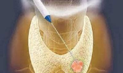 Radiofrequency Ablation (RFA) of Thyroid Nodules | Interventional ...