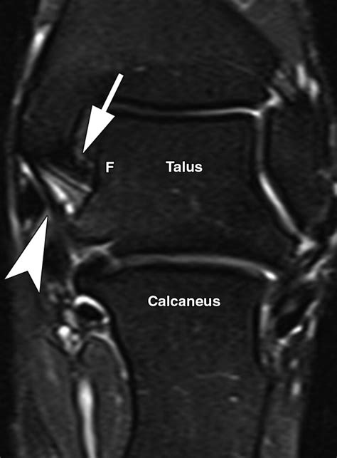 Deltoid Ligament Ankle Mri