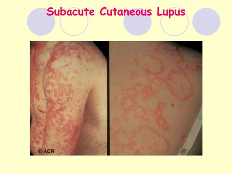 PPT - Lupus Erythematosus PowerPoint Presentation, free download - ID ...