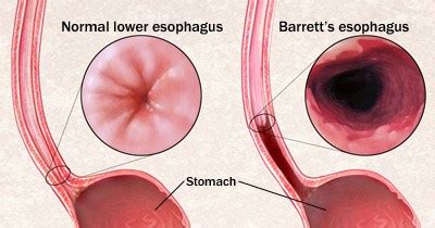 Barrett’s Esophagus Symptoms, Treatments North Dallas & Plano TX - Kedia