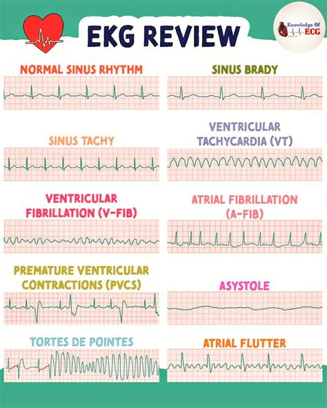 Shanu ECG On Instagram Studying For The EKG Save This Post For A