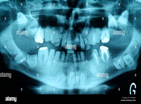 ANKYLOSIS TOOTH XRAY Stock Photo, Royalty Free Image: 49180953 - Alamy