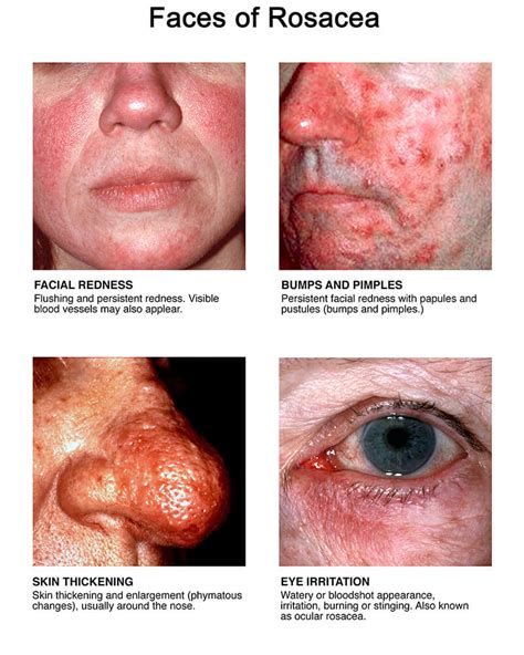 All About Rosacea: Signs & Symptoms and Treatment | Rosacea.org