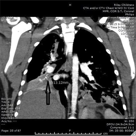 CT chest showing calcified granuloma in the right lung. | Download ...