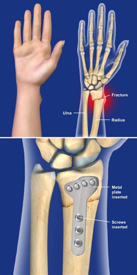 Right Distal Radius Fracture Icd 10 - Asking List